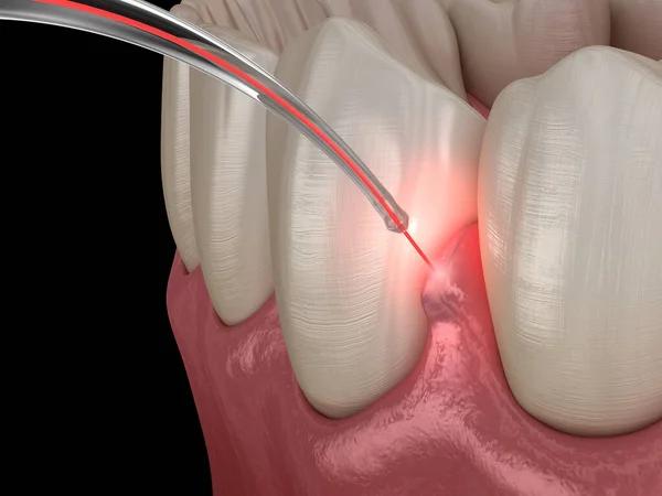 Láser dental